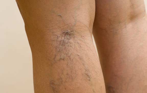 We Can Treat Your Varicose and Spider Veins
